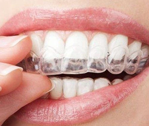 The Advantages Of Invisible Braces Over Traditional Braces